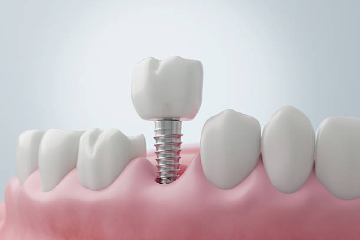 Restore Missing Teeth With Dental Implants in Clarkston
